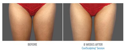 Coolsculpting Before and After - 1