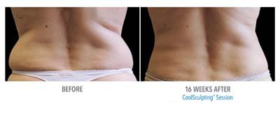 Coolsculpting Before and After - 10