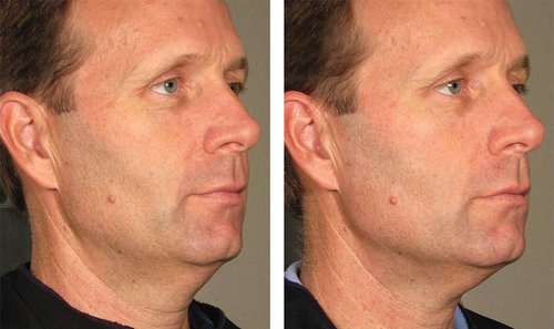 Ulthera Before and After - 1000879mkt revf patient-before-and-after-photos-maste-11