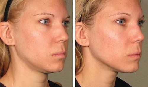 Ulthera Before and After - 1000879mkt revf patient-before-and-after-photos-maste-12