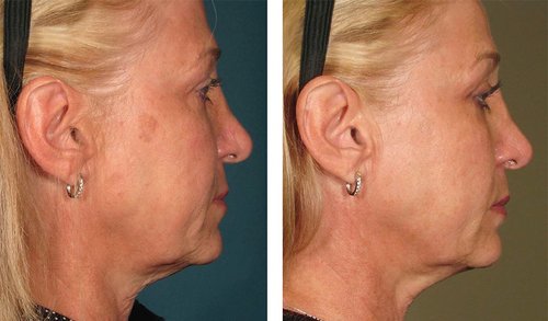 Ulthera Before and After - 1000879mkt revf patient-before-and-after-photos-maste-15
