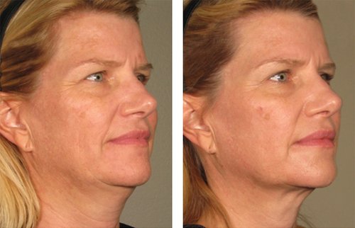 Ulthera Before and After - 1000879mkt revf patient-before-and-after-photos-maste-4