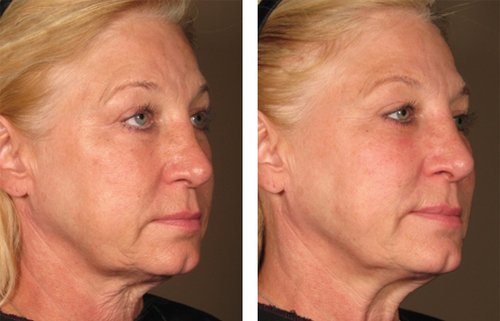 Ulthera Before and After - 1000879mkt revf patient-before-and-after-photos-maste-5