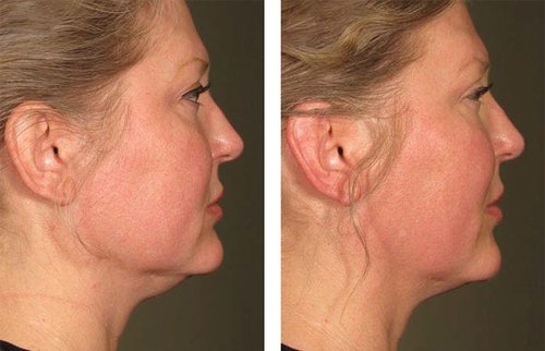 Ulthera Before and After - 1000879mkt revf patient-before-and-after-photos-maste-7