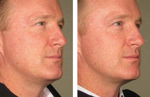 Ulthera Before and After - 1000879mkt revf patient-before-and-after-photos-maste-8