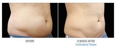 Coolsculpting Before and After - 2