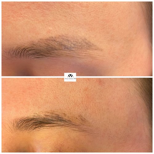 Tattoo Eyebrow Removal Before and After - 287D3222-D657-4076-B017-507D5580152D