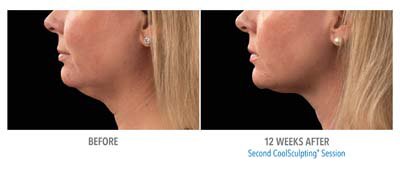 Coolsculpting Before and After - 3