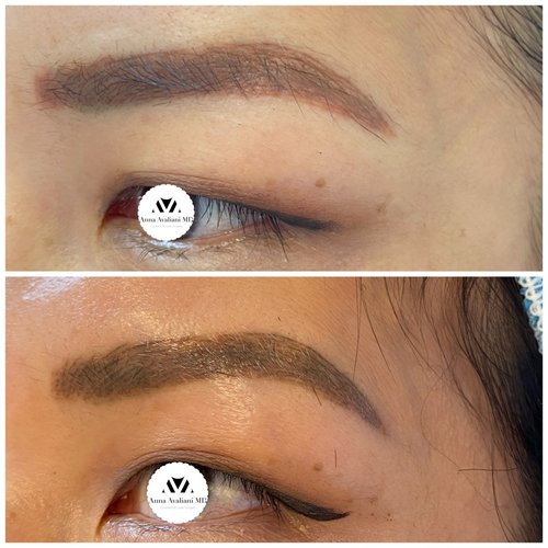 Tattoo Eyebrow Removal Before and After - 33A4BCC1-737E-4EFD-A880-09635C74219A