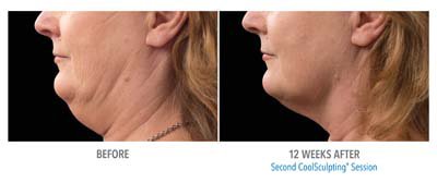 Coolsculpting Before and After - 4