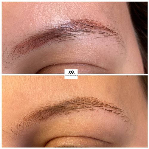 Tattoo Eyebrow Removal Before and After - 45fM2o6WosY5k ML6PVRcvdywv6l4YLMuw