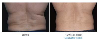Coolsculpting Before and After - 5
