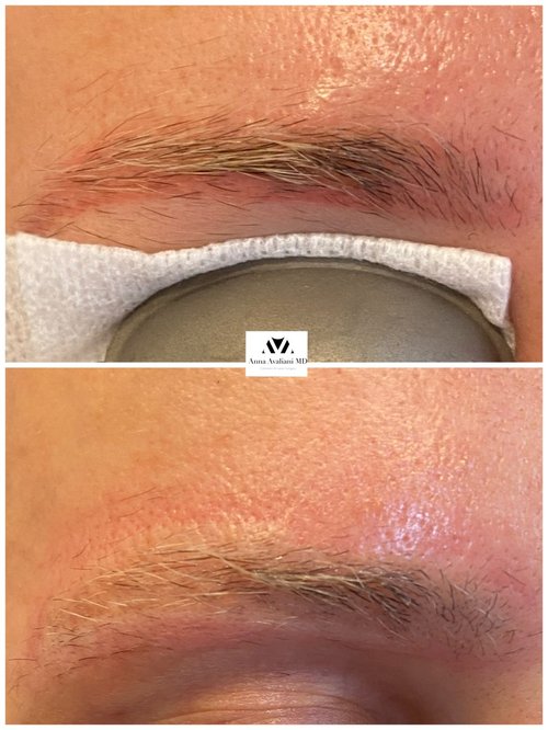 Tattoo Eyebrow Removal Before and After - 5124F666-0BEB-4FF0-883D-12FCB99F5252