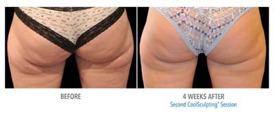 Coolsculpting Before and After - 6