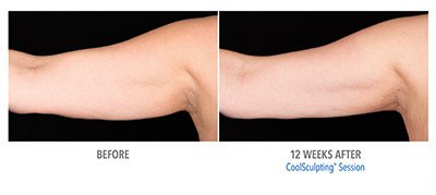 Coolsculpting Before and After - 7
