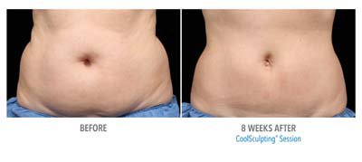 Coolsculpting Before and After - 8