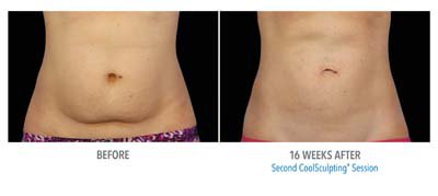 Coolsculpting Before and After - 9