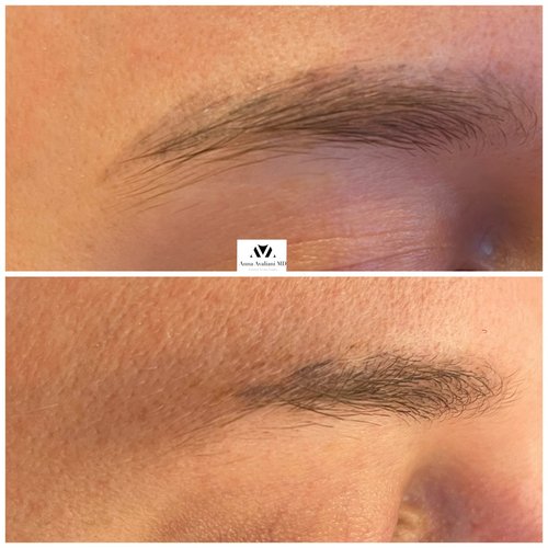 Tattoo Eyebrow Removal Before and After - 9BE0D160-DBC7-4C10-B5EA-3B92E6504DC9