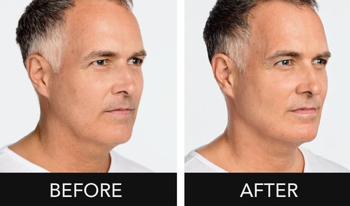 Radiesse Before and After - CikWPkg7ul66I1tI9dG7i5V9-HAPf2p6zQ.png