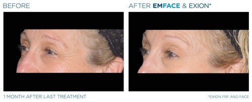 EmFace Before and After - Emface Exion PIC Ba-card-eyes-female-002 FRF Face ENUS100