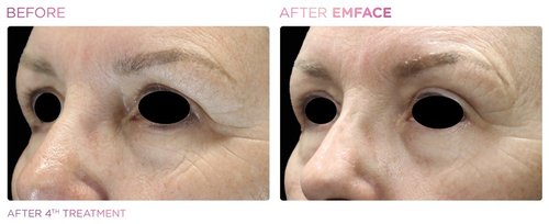EmFace Before and After - Emface PIC Ba-card-female-eyes-051 ENUS100