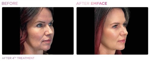EmFace Before and After - Emface PIC Ba-card-female-face-062 ENUS100