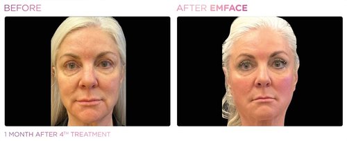 EmFace Before and After - Emface PIC Ba-card-female-face-088 ENUS100