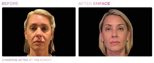 EmFace Before and After - Emface PIC Ba-card-female-face-096 ENUS100