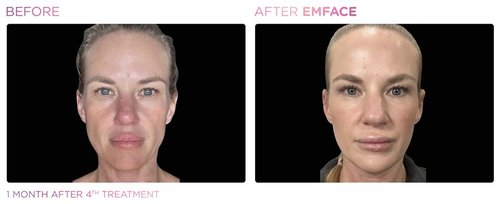 EmFace Before and After - Emface PIC Ba-card-female-face-097 ENUS100