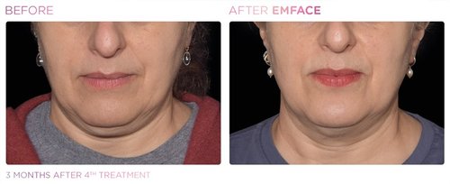 EmFace Before and After - Emface PIC Ba-card-female-submentum-035 ENUS100