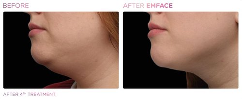 EmFace Before and After - Emface PIC Ba-card-female-submentum-108 ENUS100