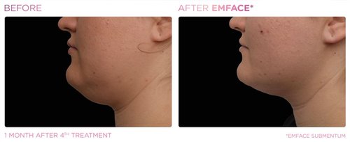 EmFace Before and After - Emface PIC Ba-card-female-submentum-121 ENUS101