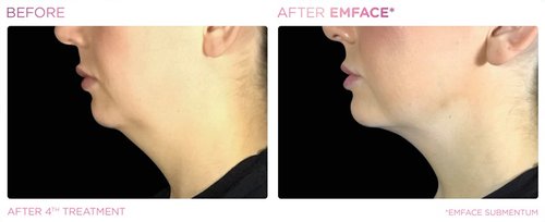 EmFace Before and After - Emface PIC Ba-card-female-submentum-127 ENUS100