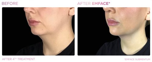 EmFace Before and After - Emface PIC Ba-card-female-submentum-128 ENUS100