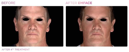 EmFace Before and After - Emface PIC Ba-card-male-face-053 ENUS100