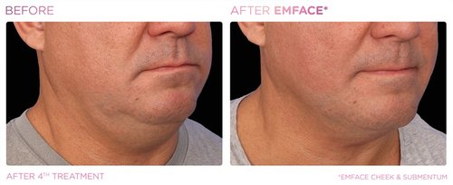 EmFace Before and After - Emface PIC Ba-card-male-submentum-115 ENUS101