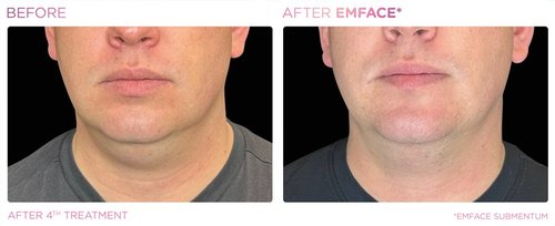 EmFace Before and After - Emface PIC Ba-card-male-submentum-125 ENUS100