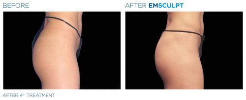 EMSCULPT Before and After - Emsculpt 10