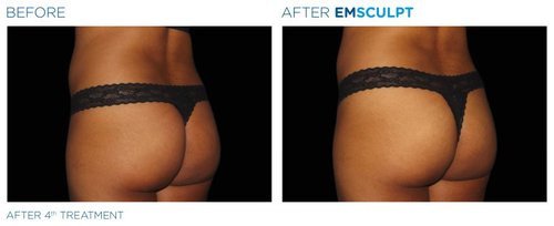 EMSCULPT Before and After - Emsculpt 11