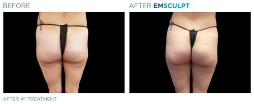 EMSCULPT Before and After - Emsculpt 12