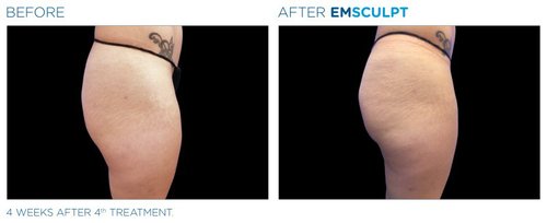 EMSCULPT Before and After - Emsculpt 13