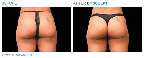 EMSCULPT Before and After - Emsculpt 14