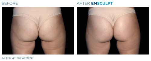 EMSCULPT Before and After - Emsculpt 15