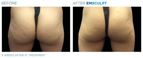 EMSCULPT Before and After - Emsculpt 16