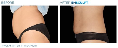 EMSCULPT Before and After - Emsculpt 17