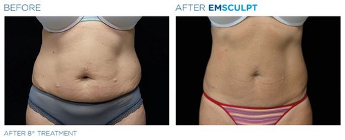 EMSCULPT Before and After - Emsculpt 18