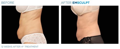 EMSCULPT Before and After - Emsculpt 2