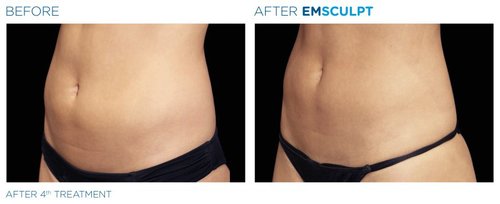 EMSCULPT Before and After - Emsculpt 3