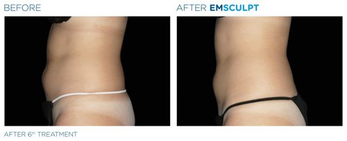 EMSCULPT Before and After - Emsculpt 4
