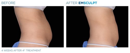 EMSCULPT Before and After - Emsculpt 5